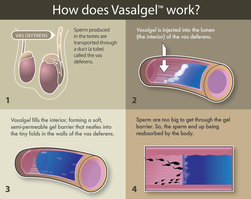 Vasalgel_Infographic_Lina-WEB