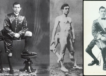 O curioso caso de Francesco Lentini, o homem de três pernas