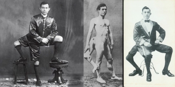 O curioso caso de Francesco Lentini, o homem de três pernas