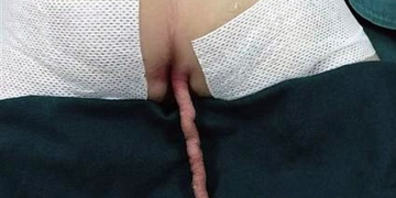 Garoto chinês nasce com um rabo de 15 centímetros