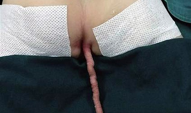 Garoto chinês nasce com um rabo de 15 centímetros