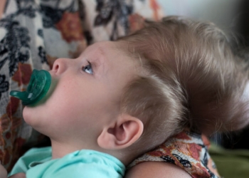 Menino que nasceu com o cérebro fora do crânio sobrevive a cirurgia