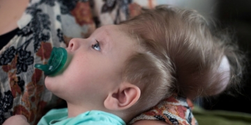 Menino que nasceu com o cérebro fora do crânio sobrevive a cirurgia