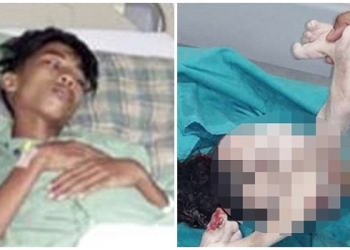 Garoto retira gêmeo do abdômen após 15 anos