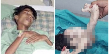 Garoto retira gêmeo do abdômen após 15 anos