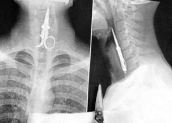 Veja 10 objetos bizarros já encontrados em raios X