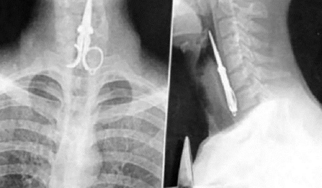 Veja 10 objetos bizarros já encontrados em raios X
