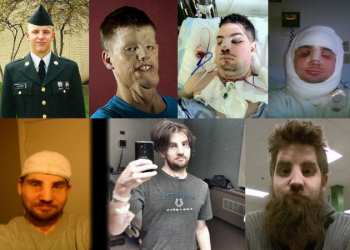 Já pensou? Esse rapaz teve o rosto inteiro transplantado