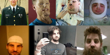 Já pensou? Esse rapaz teve o rosto inteiro transplantado