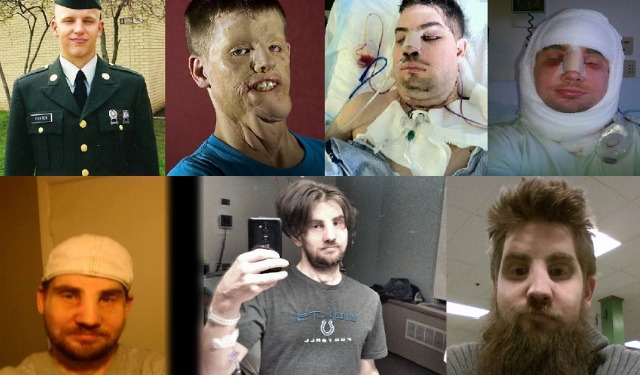 Já pensou? Esse rapaz teve o rosto inteiro transplantado