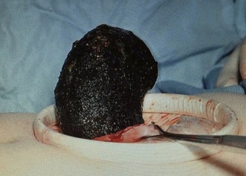 Médicos retiram 6 kg de cabelo do estômago de jovem