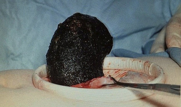 Médicos retiram 6 kg de cabelo do estômago de jovem