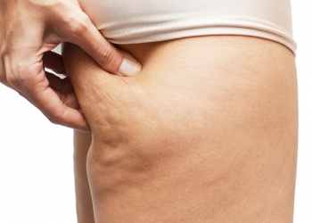 7 alimentos que potencializam o surgimento de celulite