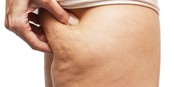 7 alimentos que potencializam o surgimento de celulite