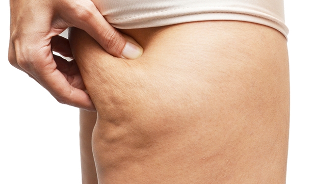 7 alimentos que potencializam o surgimento de celulite
