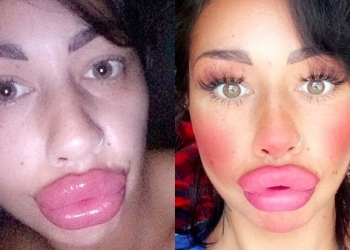 Ela gastou mais de 7 mil reais para ter essa boca