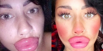 Ela gastou mais de 7 mil reais para ter essa boca