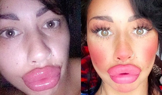 Ela gastou mais de 7 mil reais para ter essa boca