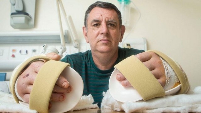 1º paciente de transplante de mãos se arrepende