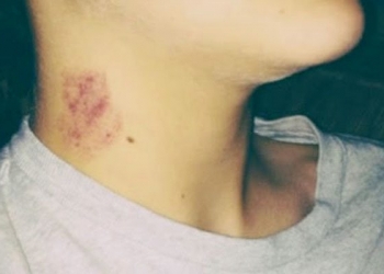 Chupão no pescoço causa morte de adolescente mexicano