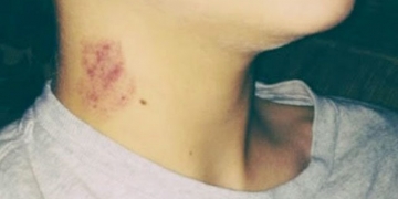 Chupão no pescoço causa morte de adolescente mexicano