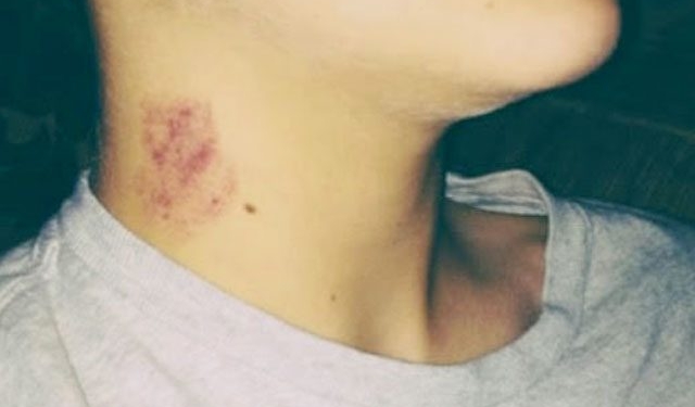 Chupão no pescoço causa morte de adolescente mexicano