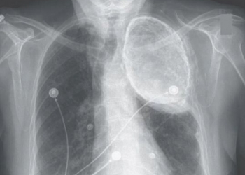 Como essa mulher teve óleo em seus pulmões por décadas?