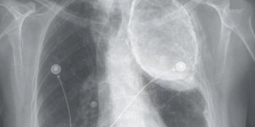 Como essa mulher teve óleo em seus pulmões por décadas?