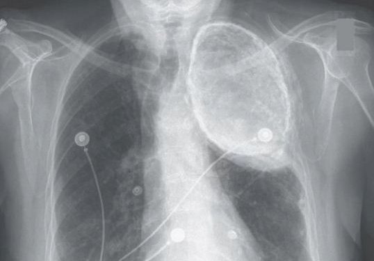 Como essa mulher teve óleo em seus pulmões por décadas?