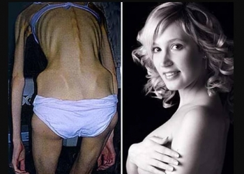 5 mulheres que venceram a anorexia e compartilharam suas histórias