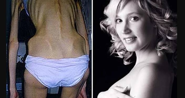 5 mulheres que venceram a anorexia e compartilharam suas histórias