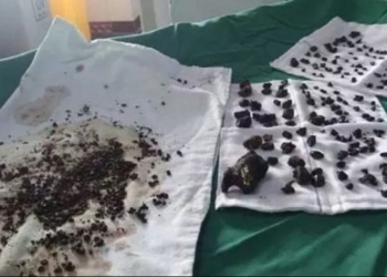 Após mais de 10 anos de dor, mulher remove mais de 200 pedras da vesícula