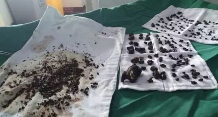 Após mais de 10 anos de dor, mulher remove mais de 200 pedras da vesícula