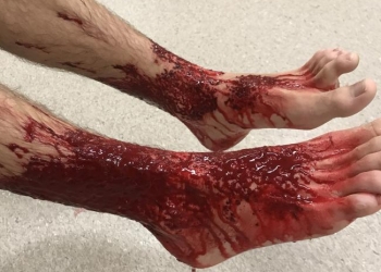 Adolescente tem pernas devoradas em praia na Austrália