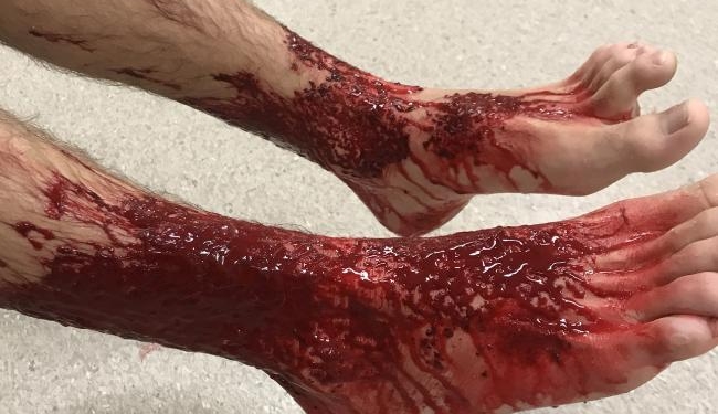 Adolescente tem pernas devoradas em praia na Austrália
