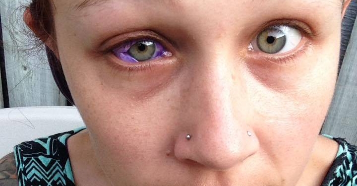 Jovem faz procedimento para pintar olho de roxo e se arrepende