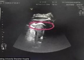 Queria nascer: bebê perfura o útero da mãe com chutes