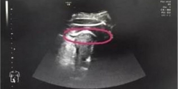 Queria nascer: bebê perfura o útero da mãe com chutes