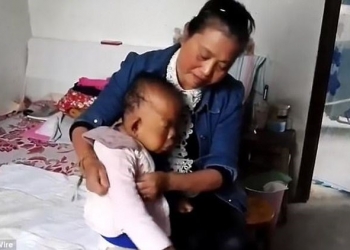 Aos 30 anos, homem tem aparência de bebê por condição rara