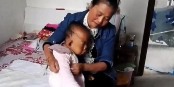 Aos 30 anos, homem tem aparência de bebê por condição rara