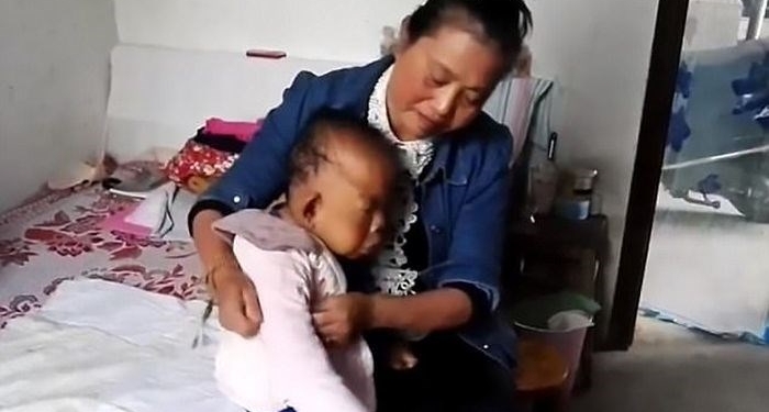 Aos 30 anos, homem tem aparência de bebê por condição rara