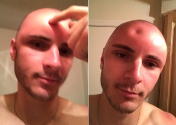 Jovem fica com a cabeça amassada por exposição ao sol