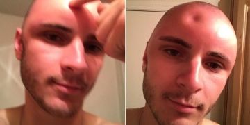 Jovem fica com a cabeça amassada por exposição ao sol