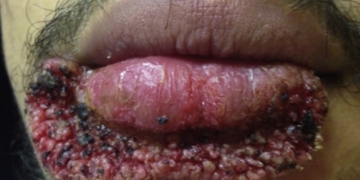 Homem remove espinha com lâmina de carpintaria e se complica