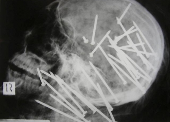 Os 10 raios-X mais impressionantes divulgados por médicos