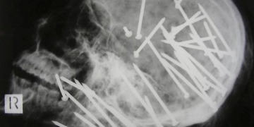 Os 10 raios-X mais impressionantes divulgados por médicos