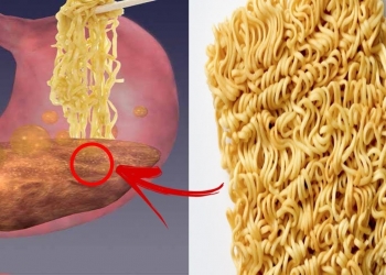 Miojo é um vilão da alimentação e muito nocivo à saúde