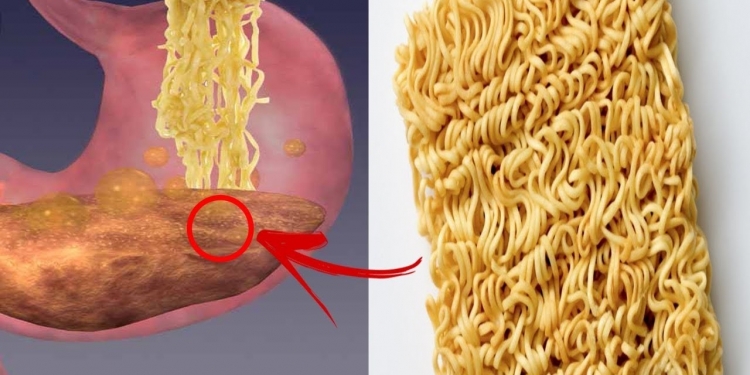 Miojo é um vilão da alimentação e muito nocivo à saúde